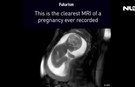 Clip thai nhi “siêu quậy” trong bụng mẹ