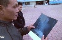 Bác sĩ quên kéo trong bụng bệnh nhân 18 năm