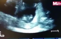 Thai nhi 14 tuần tuổi vỗ tay theo nhịp hát trong bụng mẹ