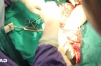 Chuyển tim, gan từ TP HCM ra Hà Nội để ghép cho bệnh nhân