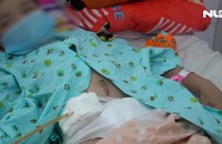 Nuốt nam châm và chuỗi hạt kim loại, bé trai 6 tuổi thủng ruột