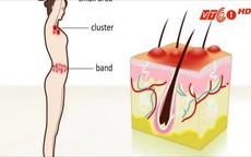 Phân biệt bệnh Zona thần kinh và giời leo