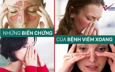 Những biến chứng nguy hiểm của bệnh viêm xoang