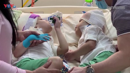 Brazil: Cặp song sinh dính đầu phức tạp nhất thế giới hồi phục sau phẫu thuật thành công