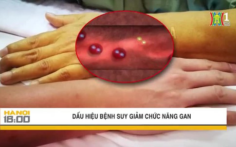 Dấu hiệu suy giảm chức năng gan