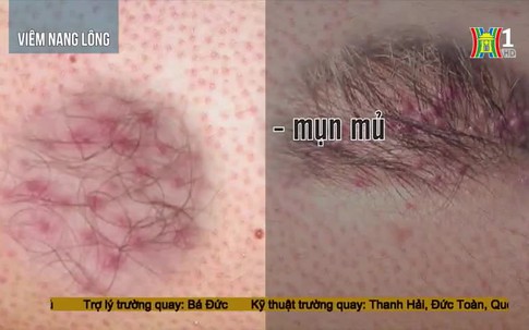 Các bệnh thường gặp trong mùa hè