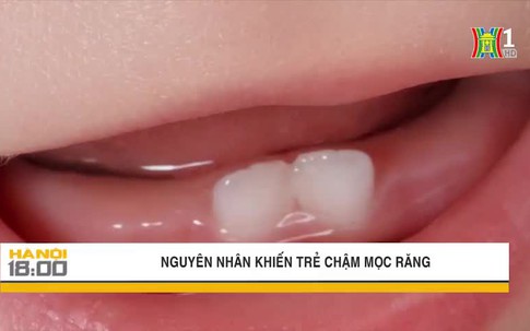 Những nguyên nhân khiến trẻ chậm mọc răng