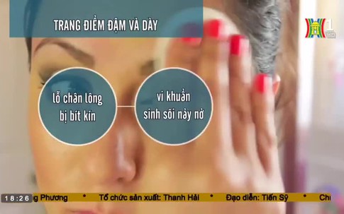 Những điều nên tránh khi bị mụn trứng cá