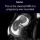 Clip thai nhi “siêu quậy” trong bụng mẹ